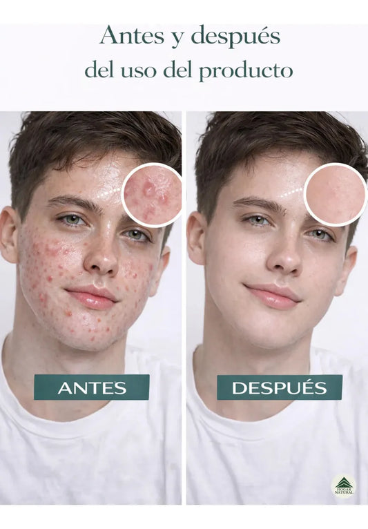 🧼Sérum Ácido Salicílico + Parches Invisibles ✨